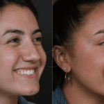 Preventing the Crinkle: A Facial Plastic Surgeon Weighs in on the Preventative Botox Debate