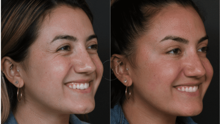 Urban Facial Plastics before and after