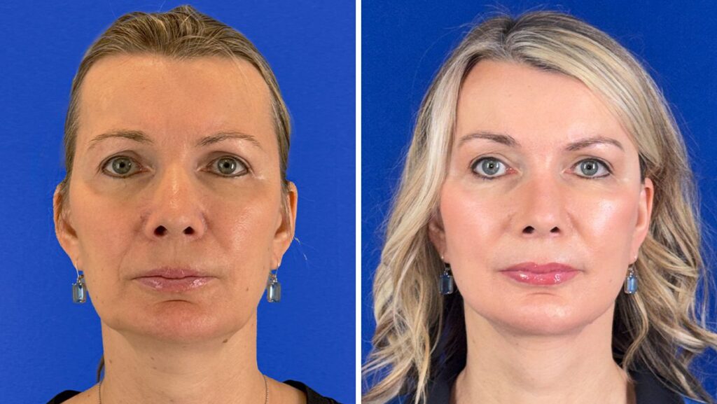 My Plastic Surgeon Husband Did My Facelift and Now He Is Going Out With a Younger Woman