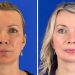 My Plastic Surgeon Husband Did My Facelift and Now He Is Going Out With a Younger Woman