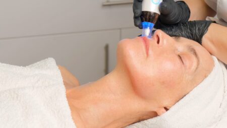 Microneedling skin renewal