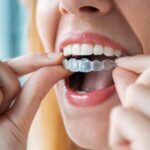 Invisalign 101: Expert Tips for a Seamless Treatment Experience