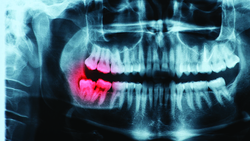 5 Signs You May Need Your Wisdom Teeth Removed