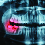 5 Signs You May Need Your Wisdom Teeth Removed