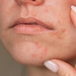 Perioral Dermatitis: What It Is and How to Treat It