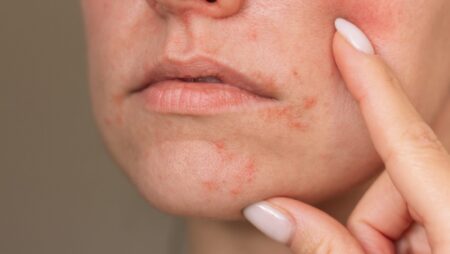 Perioral dermatitis