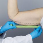 Brachioplasty (Arm Lift): Surgery, Recovery, and What to Expect