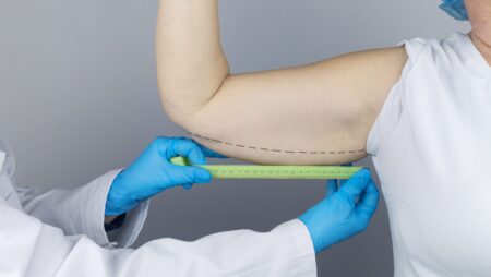 Preparing for brachioplasty arm lift surgery