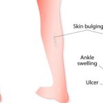 New Year, Healthy Legs: Why January Is the Perfect Time to Evaluate Varicose Veins