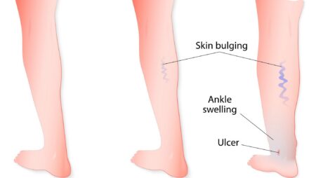 Vein & Laser Center of New Jersey Addressing Varicose Veins