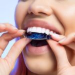 Retainers: Protect Your Investment and Maintain Your New Smile