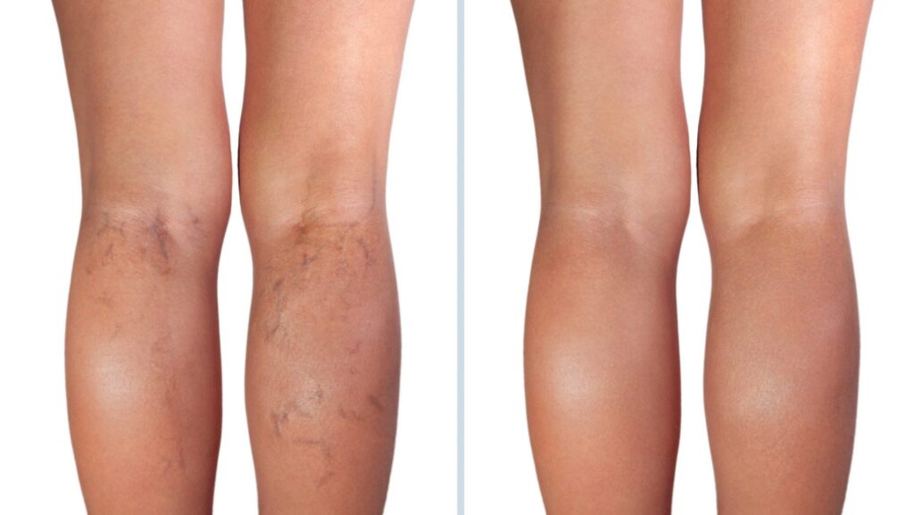 Step into Spring Legs without Spider Veins this year