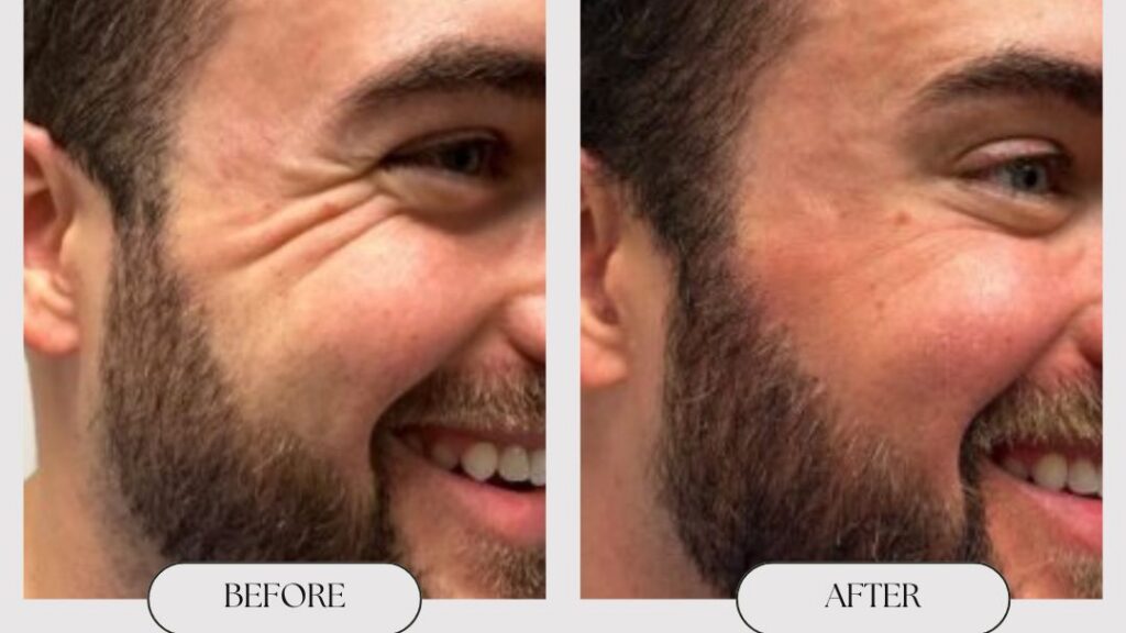 Botox vs. Filler: What’s the Difference?