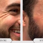 Botox vs. Filler: What’s the Difference?