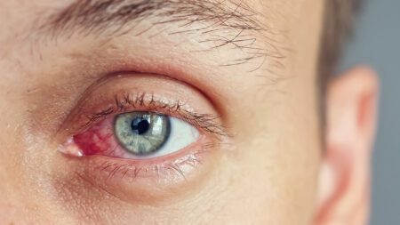 Dry infected eye