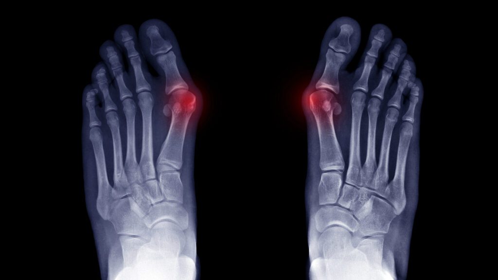 Bunions: How to Slow Them Down, Protect the Next Generation, and Know When Surgery Is Truly Needed