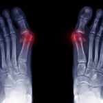 Bunions: How to Slow Them Down, Protect the Next Generation, and Know When Surgery Is Truly Needed