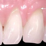 Ask the Dentist: Is it Okay to Drink Carbonated Water?