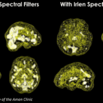 A Common, But Relatively Unknown Visual Processing Disorder
