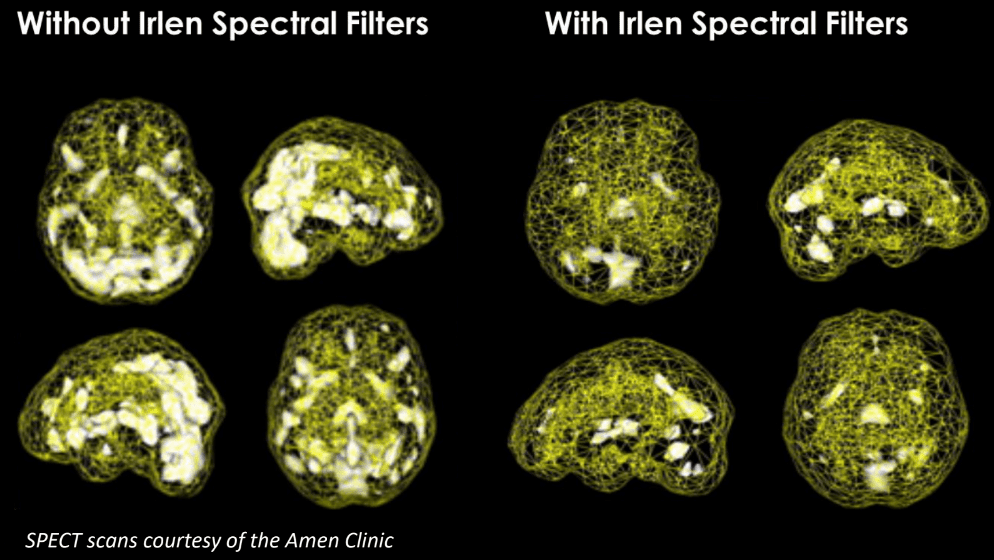 A Common, But Relatively Unknown Visual Processing Disorder