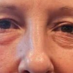 Lumenis OptiLIFT: New Technology for a Gentle Eyelid and Facelift Without Downtime or Surgery