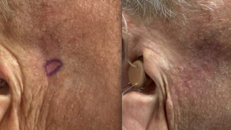 Mohs Surgery before and after Care Dermatology And Skin Cancer Centers