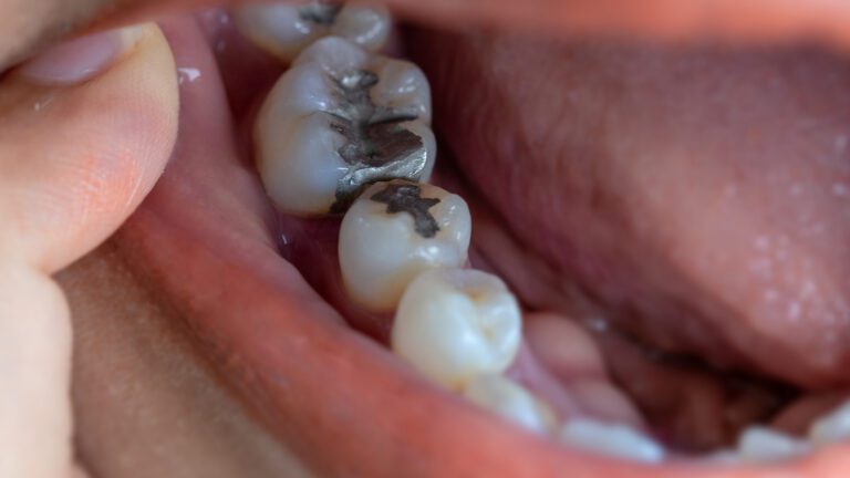 A Whole-Body Approach: Should I Remove My Old Silver Amalgam Fillings?