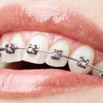 O’Keiff Orthodontics: New Year, New You Orthodontics at Every Age