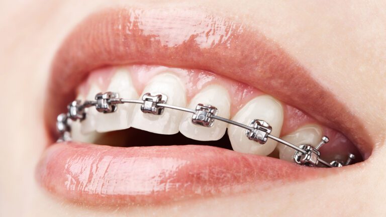When Is the Right Time for Braces?