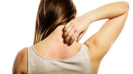 Woman scratching back itchy dry skin