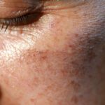 Lasers in Medicine: A New Era in Skin Treatment