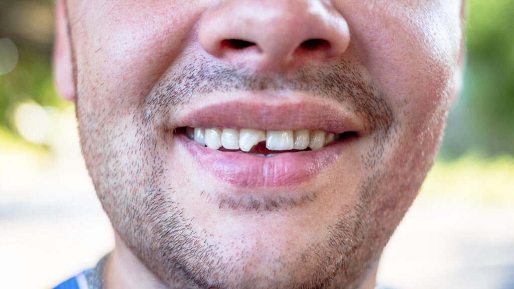 Dental and Facial Injuries from E-Bike Accidents