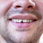 Dental and Facial Injuries from E-Bike Accidents