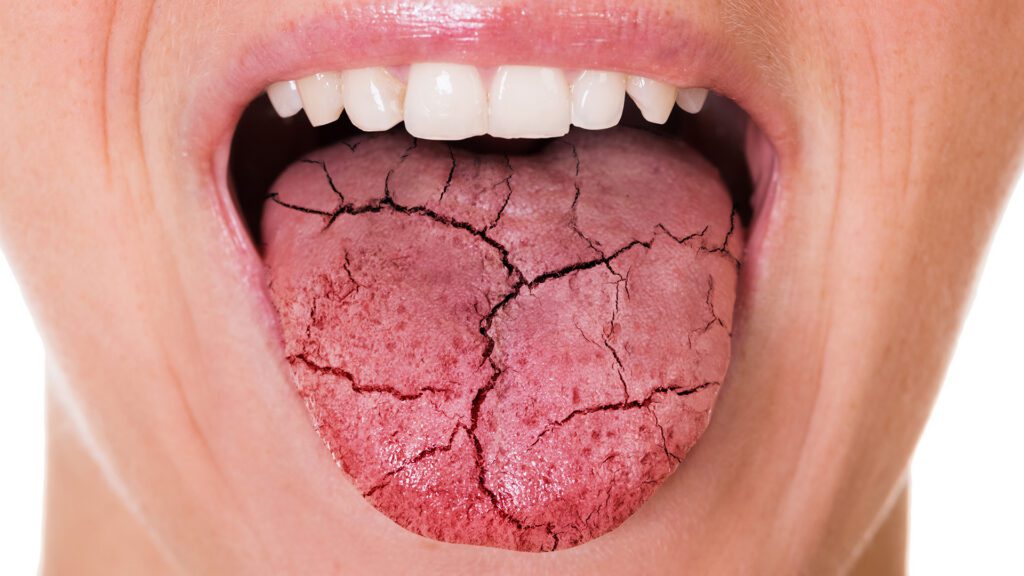 Dry Mouth: More Than Just an Annoyance