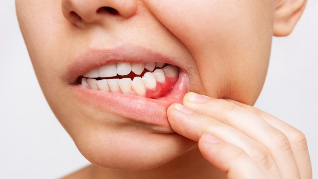 What Is Periodontal (Gum) Disease?