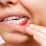 What Is Periodontal (Gum) Disease?