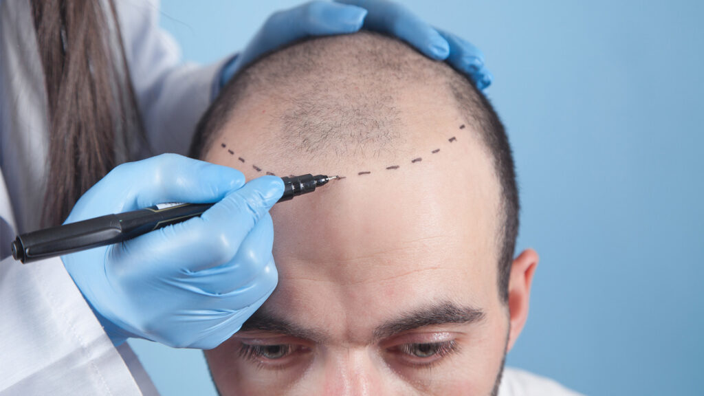 Why You Don’t Need to Travel to Turkey for Hair Transplants