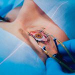 The Future of Clear Sight: The Advantages of Laser-Assisted Cataract Surgery