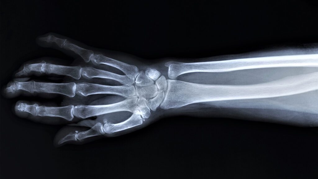 Hand Truths: Busting the Biggest Myths About Hand and Elbow Injuries