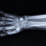 Hand Truths: Busting the Biggest Myths About Hand and Elbow Injuries