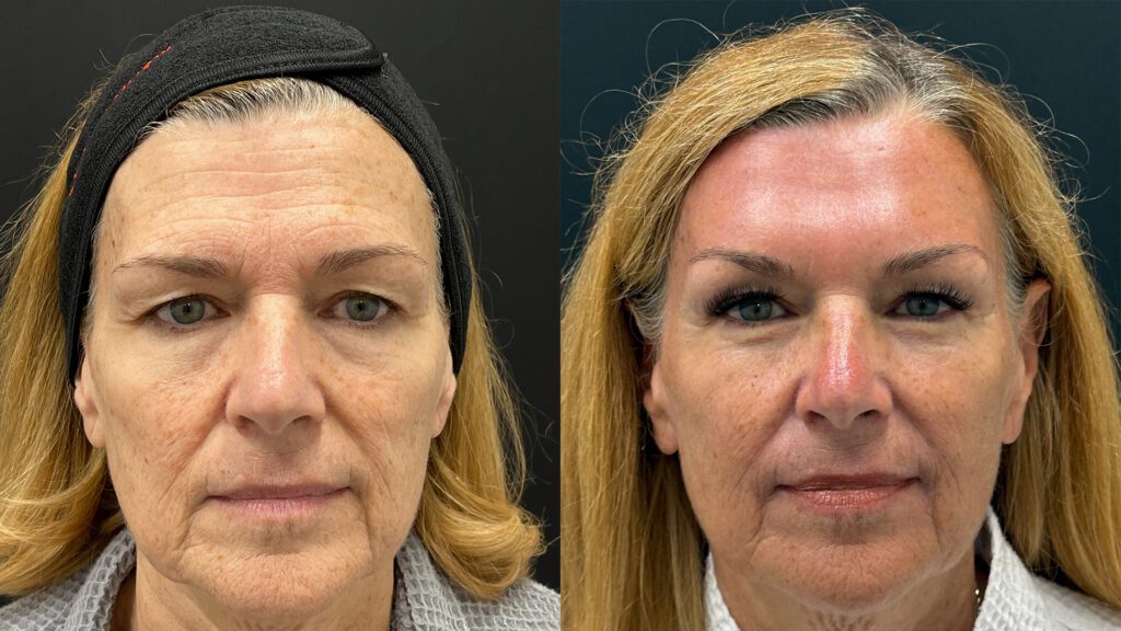 Opening the Eyes: The Art of Combining Brow Lift and Upper Blepharoplasty