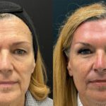Opening the Eyes: The Art of Combining Brow Lift and Upper Blepharoplasty