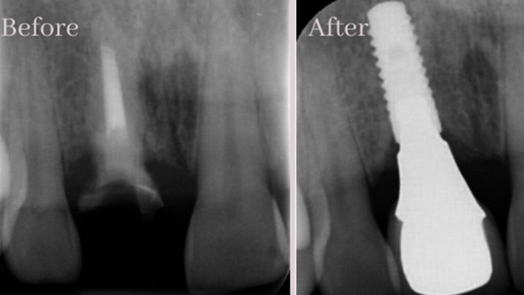 To Implant or Not Implant — That Is the Question