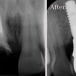 To Implant or Not Implant — That Is the Question