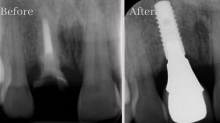 Dental Implant X-ray Kettle Valley Family Dental