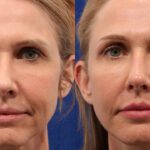 The ‘Forever 35 Face’: The Undetectable Deep-Plane Facelift Is Changing the Aesthetic Landscape