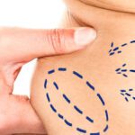 Safe, Effective, Healthy: Fat Loss With Zerona Z6