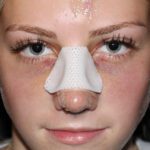 Rhinoplasty Recovery: Elegance Takes Time