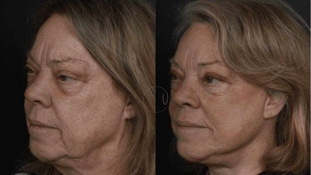 Beyond Skin Deep: The Truth About Treating a “Turkey Neck”