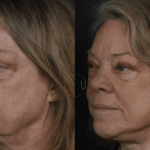 Beyond Skin Deep: The Truth About Treating a “Turkey Neck”